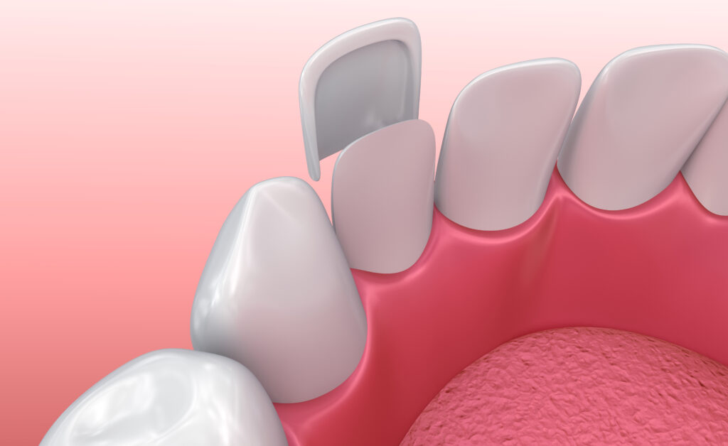 Veneers oder Zahnblenden, bevor Sie auf die Zahnoberfläche angeheftet werden.